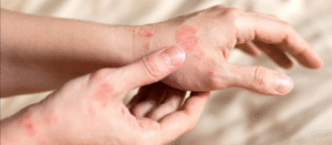 Azithromycin Purchases